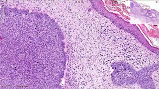 Basal Cell Carcinoma Including Variants  Histopathology [upl. by Lauren]