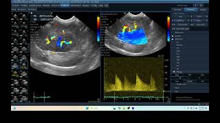 IQ 279 LIVER ULTRASOUND HEPATOMA ECHOPAC ANALYSIS ECHOCARDIOGRAPHY DOPPLER MODE [upl. by Rotow]