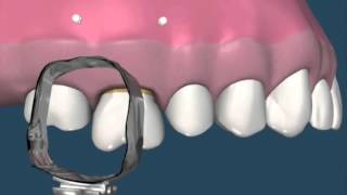 Molar intrusión con implantes  Ortodoncia [upl. by Anirbac]