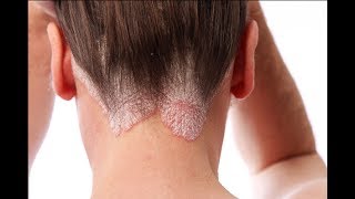 How to Treat Scalp Scabs [upl. by Alue]