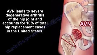 Avascular Necrosis Osteonecrosis  Everything You Need To Know  Dr Nabil Ebraheim [upl. by Ferdie2]