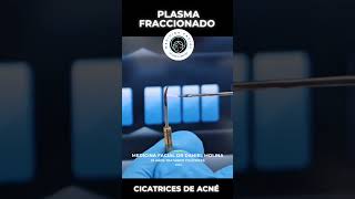 Plasmage para cicatrices de acné acnescars cicatrizdeacne cicatrizacion pielperfecta [upl. by Girish]