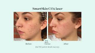 Laser Treatments at The Skin Center [upl. by Nnyleuqcaj]