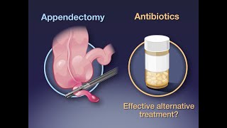 Antibiotika versus Appendektomie bei Appendizitis  NEJM 2020 [upl. by Lrig]