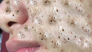 Big Cystic Acne Blackheads Extraction Blackheads amp Milia Whiteheads Removal Pimple Popping  3533 [upl. by Otrebliw]