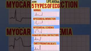 5 ECG Types Spot the Hearts Signals 🫀ECG hearthealth Cardiology healthtips Medical Shorts [upl. by Liva]