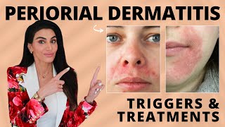 Perioral Dermatitis Triggers amp Treatment Recommendations by a Dermatologist [upl. by Zacks]