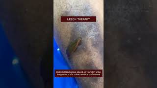 Leech Therapy [upl. by Gelasius]