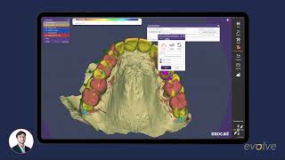 BiteFinder 31 Tramuntana Exocad Integration Immediate denture Ivoclar ivotion by Jonny evolve [upl. by Gilligan]