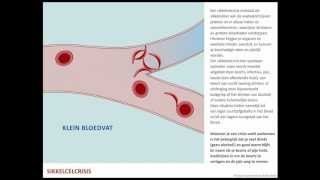 Sikkelcelcrisis  Sikkelcelziekte [upl. by Botti]