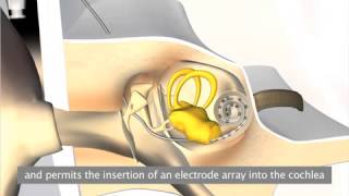 How a cochlear implant works  Neurelec [upl. by Mello]