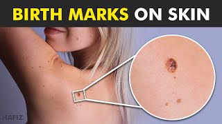 Birthmarks Understanding the Types Causes and Treatment Options [upl. by Niasuh439]