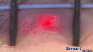 Rejuvenescimento a Laser Fracionado  Smartxide CO2  Deka Lasers  O Laser e sua ponteira [upl. by Annavaig]