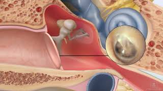 Repair a perforated ear drum using ClearDrum [upl. by Emanuele220]