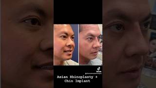 Asian rhinoplasty and Chin Implant asianrhinoplasty chinimplant rhinoplasty nosebynarasimhan [upl. by Gibbie]