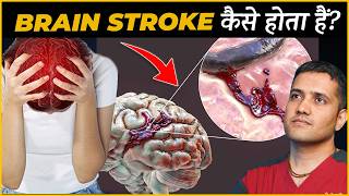 Causes Symptoms And Treatment Of Ischemic Brain Stroke  Dr Gaurav Gangwani IR [upl. by Darci]