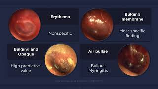 Acute Otitis Media Otoscopic Findings [upl. by Staford735]