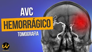 AVC HEMORRÁGICO com Sinais de Hidrocefalia Hipertensiva [upl. by Cassius]