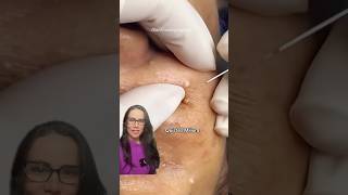 Quistes Milium acne viralvideo facial [upl. by Just]