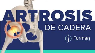 ARTROSIS DE CADERA 😡 dolor de cadera  tratamientos naturales osteoartritis de cadera [upl. by Caren]