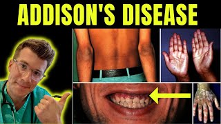 Doctor explains Addisons disease Adrenal insufficiency definition symptoms treatment amp more [upl. by Hadrian148]