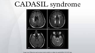 CADASIL syndrome [upl. by Richter386]