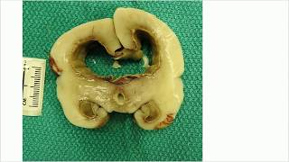 Bacterial ventriculitis in prematurity  Adventures in Neuropathology [upl. by Spiegleman]