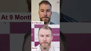 Hair Transplant Before and After  Men Hair Transplant Before and After Results [upl. by Aline]