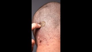 ✅ Consejos para la Dermatitis SEBORREICA en el cuero cabelludo [upl. by Drofkcor336]