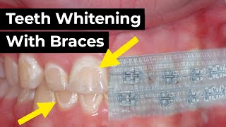 Teeth Whitening with Braces [upl. by Emarej]