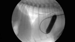 Interventional Cardiology Pulmonic Stenosis PS Ballooning [upl. by Moriyama271]