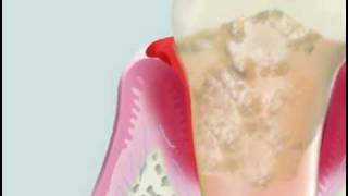 Cavitron on severe periodontitis [upl. by Wandy]