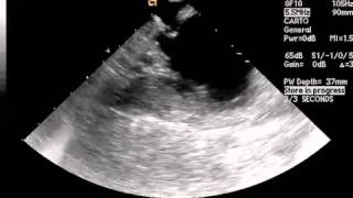 Video 92  Interventional Cardiac Electrophysiology [upl. by Tezil]