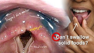 Cricopharyngeal Dysfunction Difficulty Swallowing Especially Solid Foods [upl. by Morgenthaler]