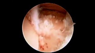 Subtalar Joint Arthroscopy Debridement SFISM [upl. by Rica]