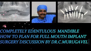 Completely edentulous mandible  how to plan for full mouth implant surgery [upl. by Annoeik]