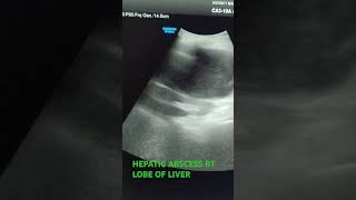 HEPATIC ABSCESS RT LOBE usg [upl. by Ahtreb]