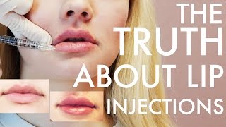 Getting Lip Injections from a Doctor  Filler 101 and Common Myths [upl. by Anyrak517]