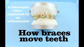 How braces move teeth timelapse  Braces Explained [upl. by Barbee]