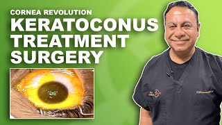 Keratoconus Surgery Laser Treatment [upl. by Ezzo]