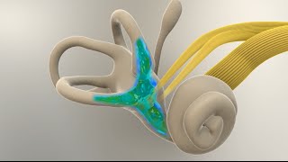 Menieres Disease  What Happens in the Inner Ear [upl. by Iddo662]