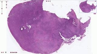 Mixed Cellularity Hodgkin Lymphoma  Histopathology [upl. by Mclain]