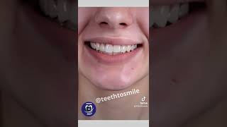 Unbelievable Smile Transformation Before amp After Dental Makeover Revealed 🌟 shorts [upl. by Artimed]