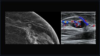 Achados mamográficos e ecográficos típicos dos linfonodos intramamários [upl. by Ruthe2]