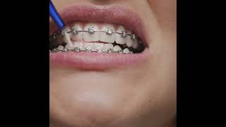 How To Clean Your Tooth After Braces Treatment  All Brite Dentistry [upl. by Sada]