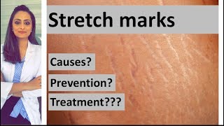 How to beat stretch marks during pregnancy by using Palmers [upl. by Durante]