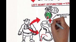 Pulmonary edema USMLE step 1 [upl. by Ecyak103]