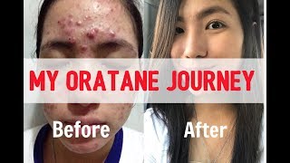 CYSTIC ACNE lifechanging Solution  ORATANE  Before amp After [upl. by Eresed908]