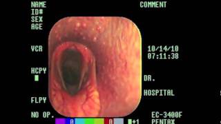 Laryngeal Hemiplegia Explained m4v [upl. by Asyram421]