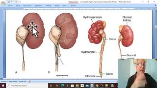 Urosurgery in Arabic 21  Hydronephrosis   by Dr Wahdan [upl. by Heda22]